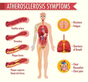 atherosclerosis